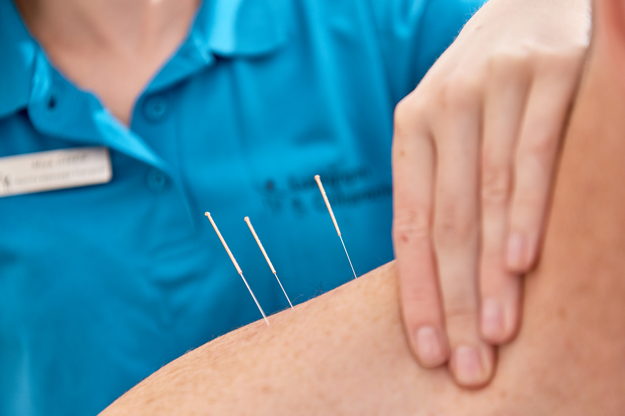 Image shows acupuncture needles being used to treat a shoulder